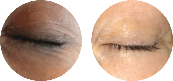 Periorbital Before & After