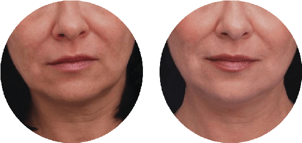Jowl / Submental Before & After